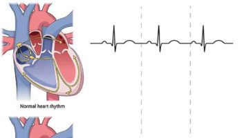 ventricular tachycardia