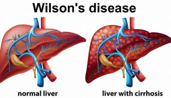 wilson’s disease
