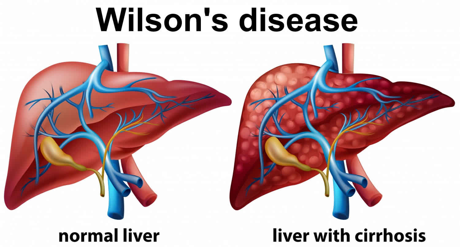 Wilson's disease causes, symptoms, prognosis, diagnosis, test & treatment