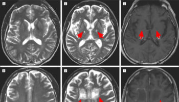 Adrenoleukodystrophy