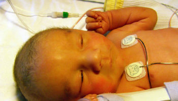 Alagille syndrome
