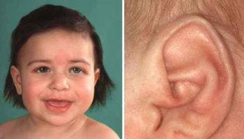 Beckwith Wiedemann syndrome