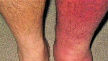 Cellulitis