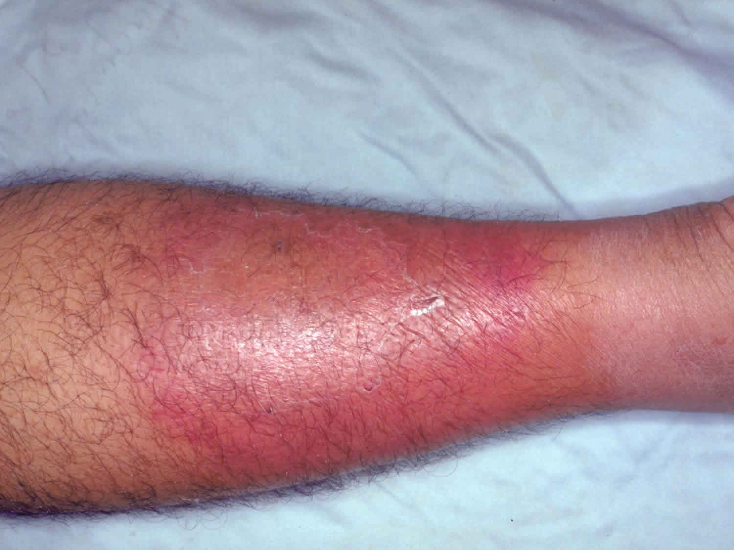 Cellulitis causes, signs, symptoms, diagnosis, prevention and treatment