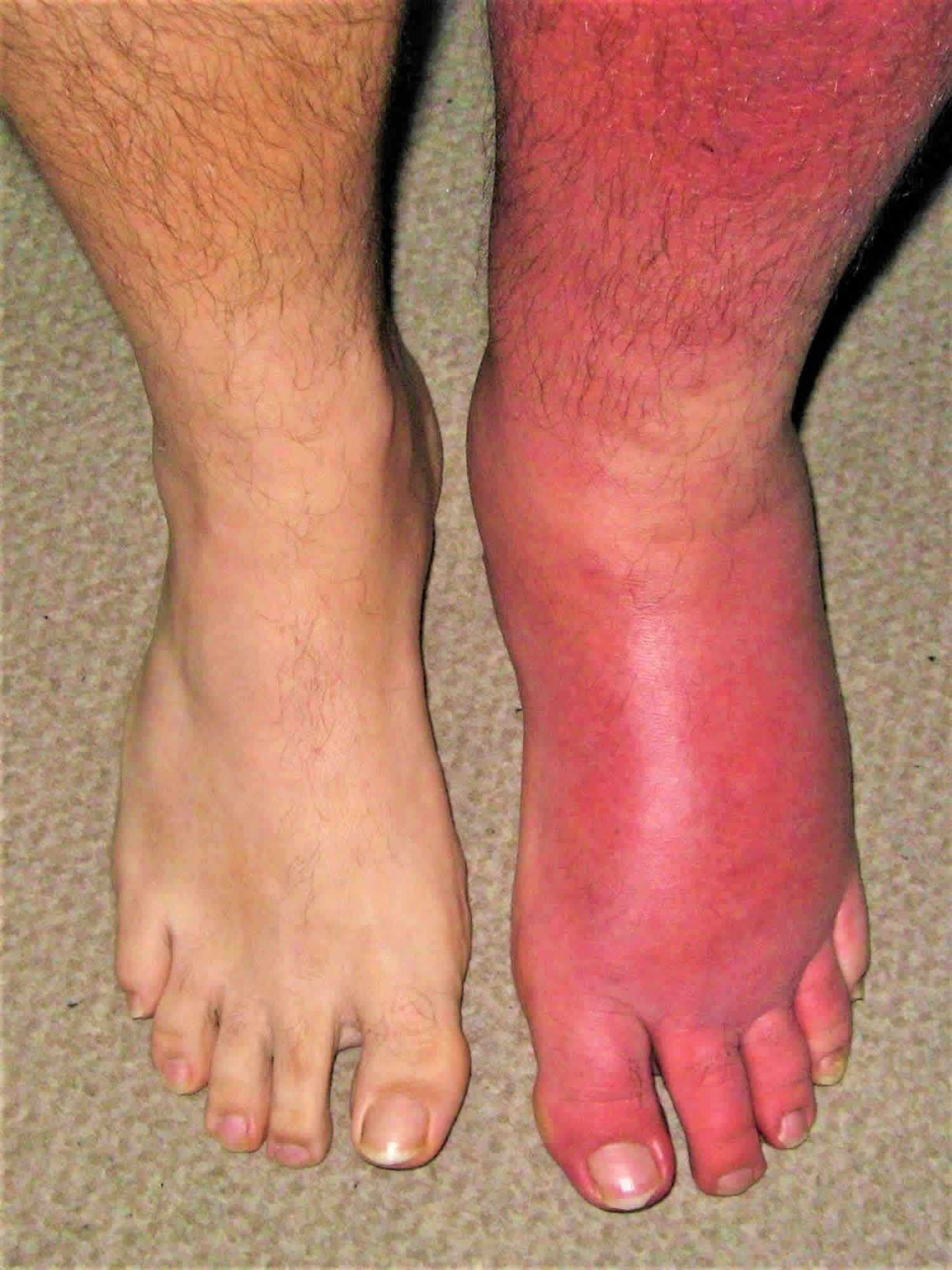 cellulitis crypto