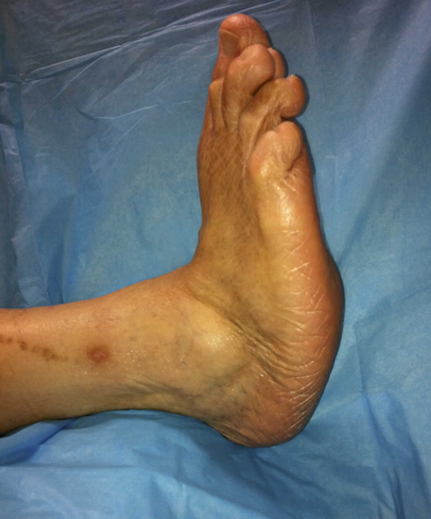Charcot foot in diabetes