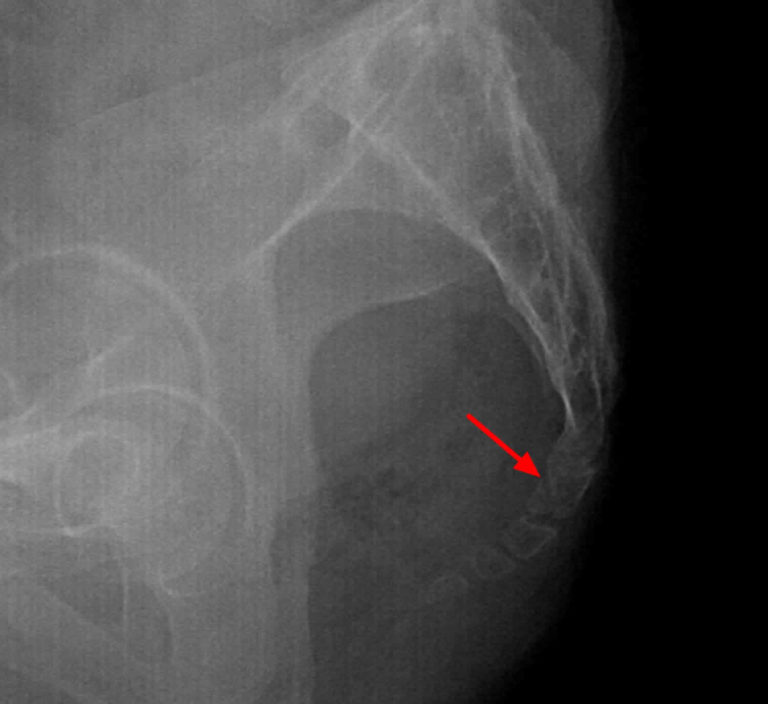 closed fracture of sacrum