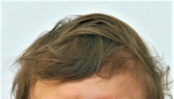 Crouzon syndrome