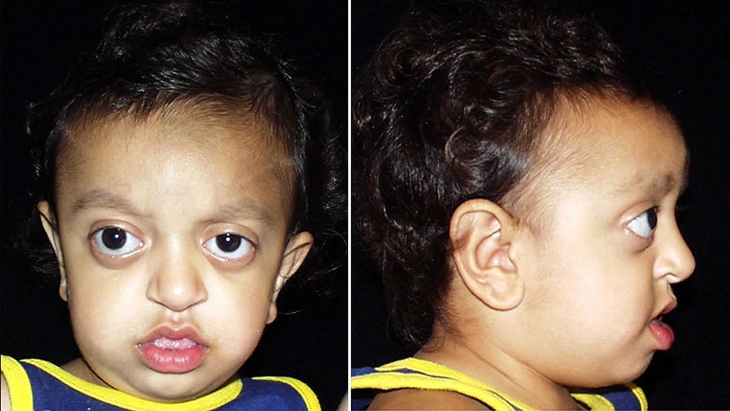 Crouzon syndrome causes, symptoms and Crouzon syndrome treatment