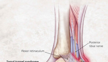 Heel pain