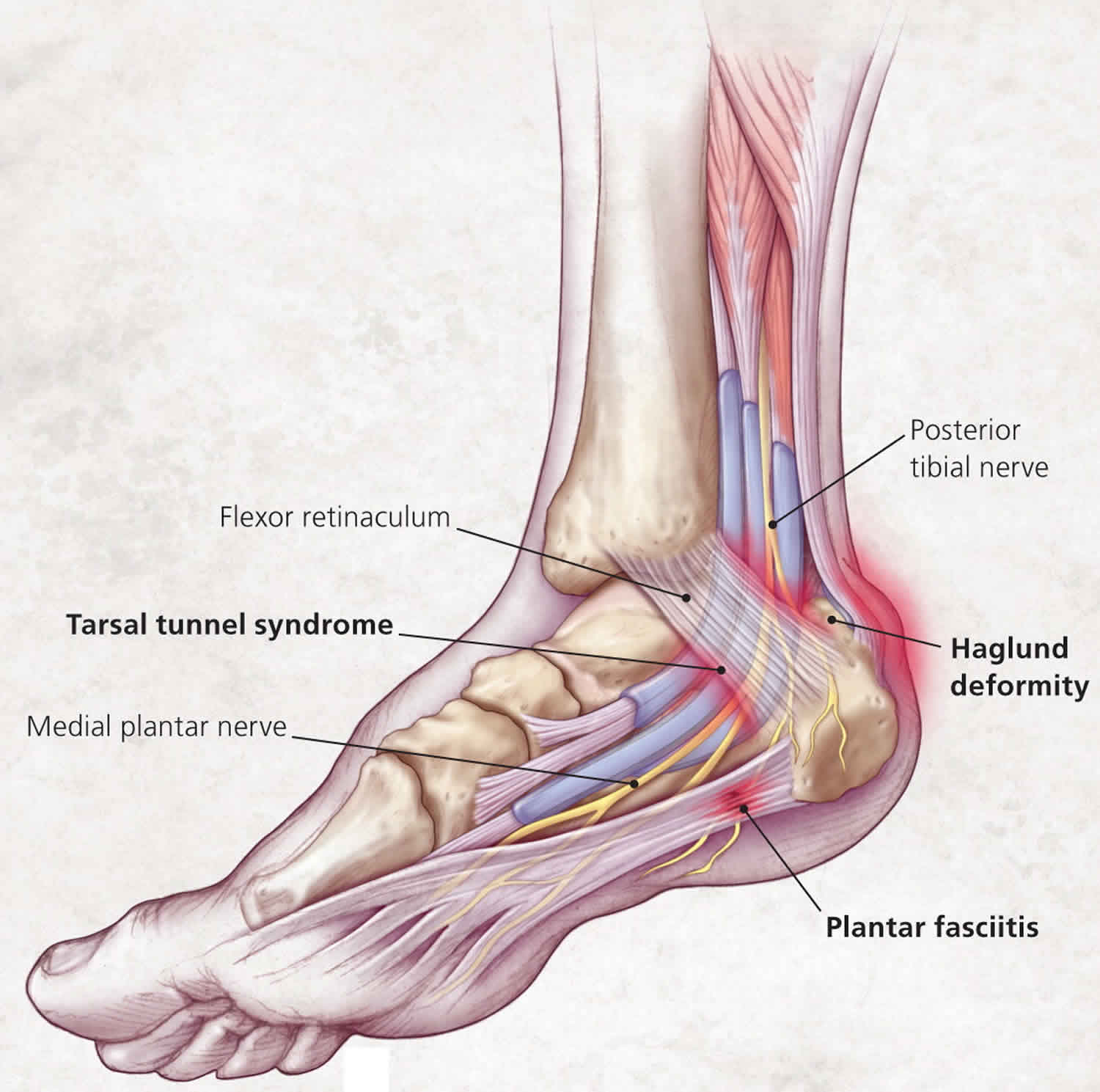 Heel Pain Causes Symptoms Diagnosis Pain Relief Heel Pain Treatment