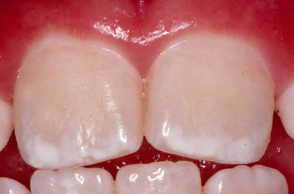 Dental fluorosis causes, prevention, symptoms & dental fluorosis treatment