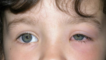 Periorbital_cellulitis