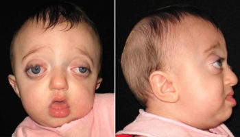 Pfeiffer syndrome