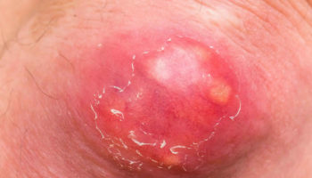 abscess