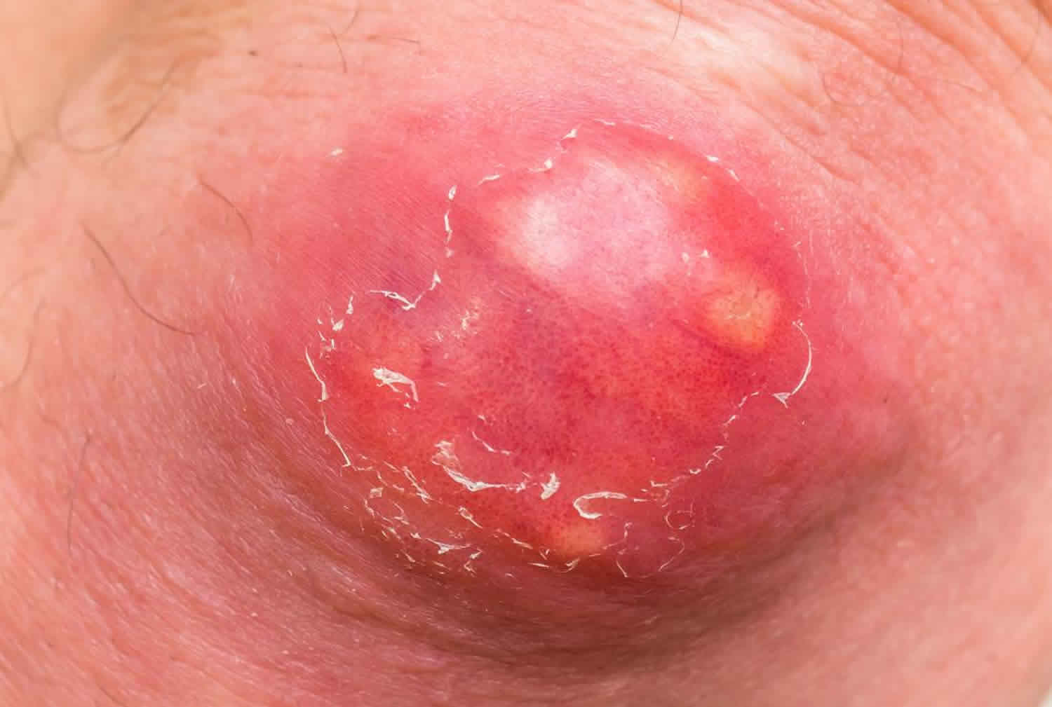 Abscess Causes, Signs, Symptoms, Types And How To Treat An Abscess-3211