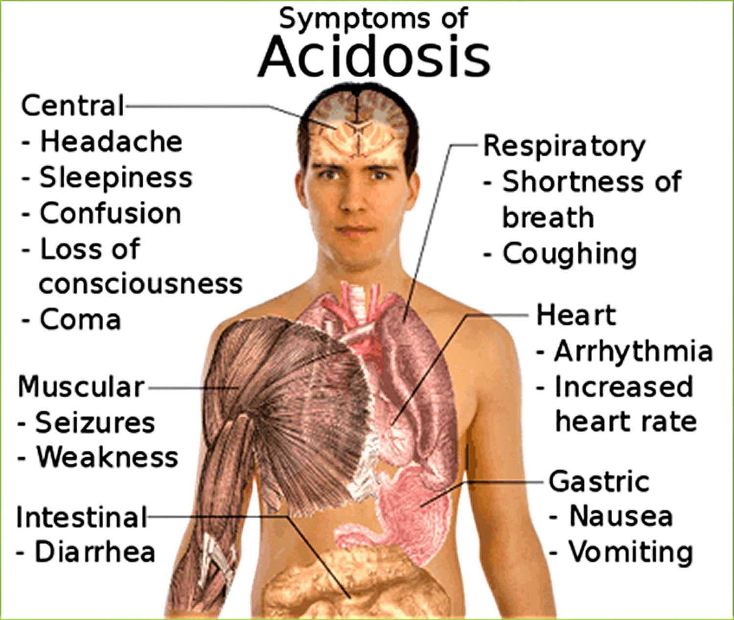 Acidosis Cause Metabolic Acidosis Causes Symptoms Diagnosis Treatment