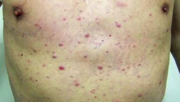 acute myeloid leukemia