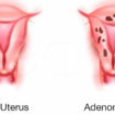 adenomyosis