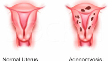 adenomyosis