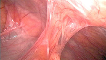 adhesions
