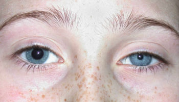 anisocoria
