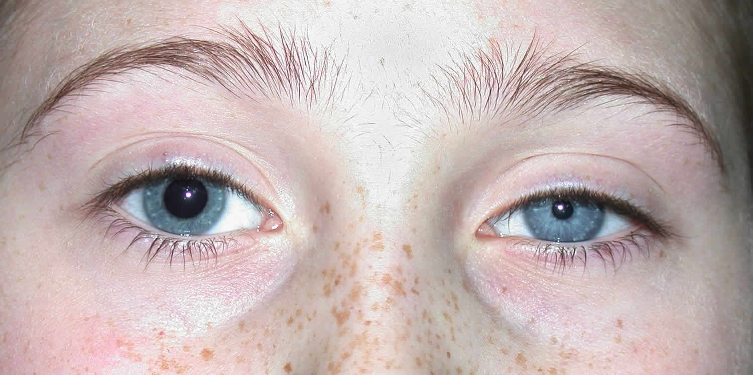 anisocoria definition