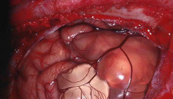 arachnoid cyst