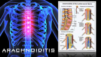 arachnoiditis
