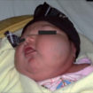 cystic hygroma