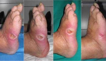 diabetic foot