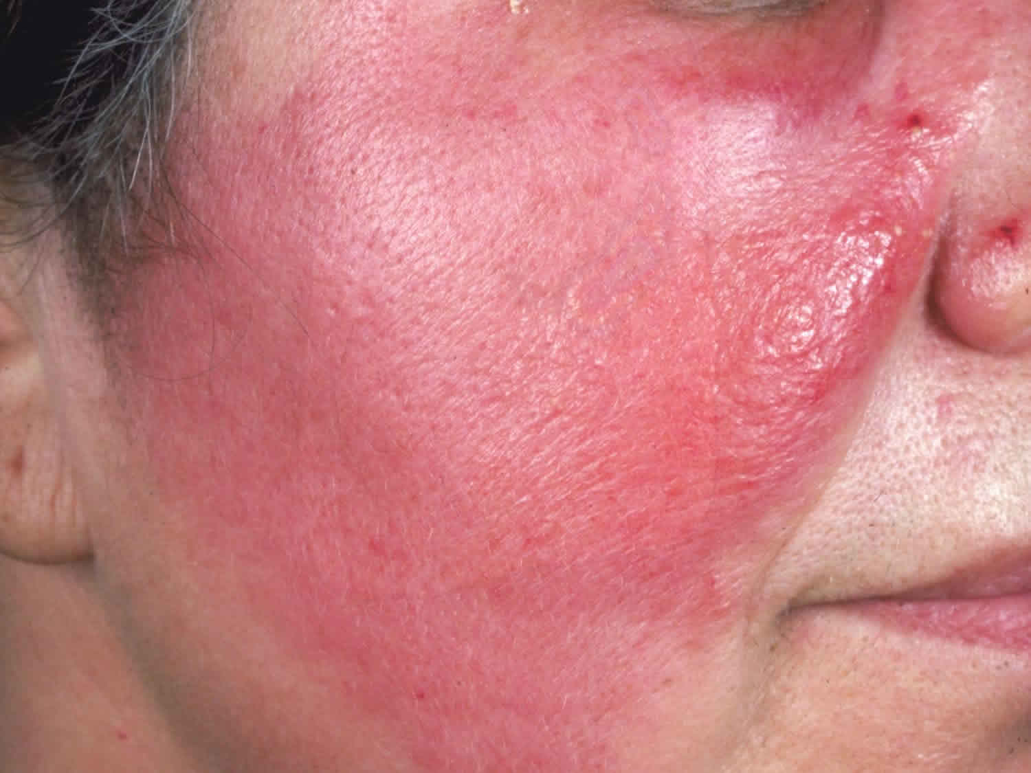 pictures of skin cellulitis