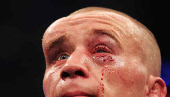 hematoma