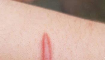 hypertrophic scar