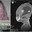 lissencephaly