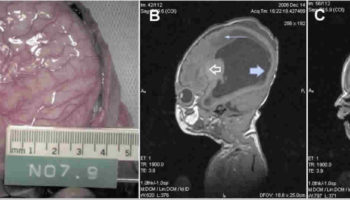 lissencephaly