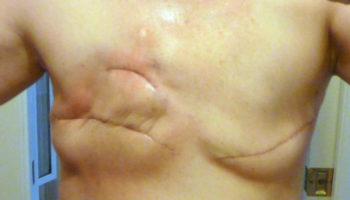 mastectomy