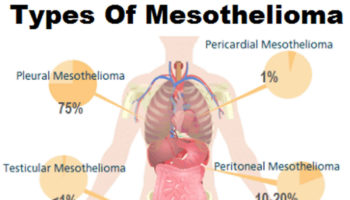 mesothelioma