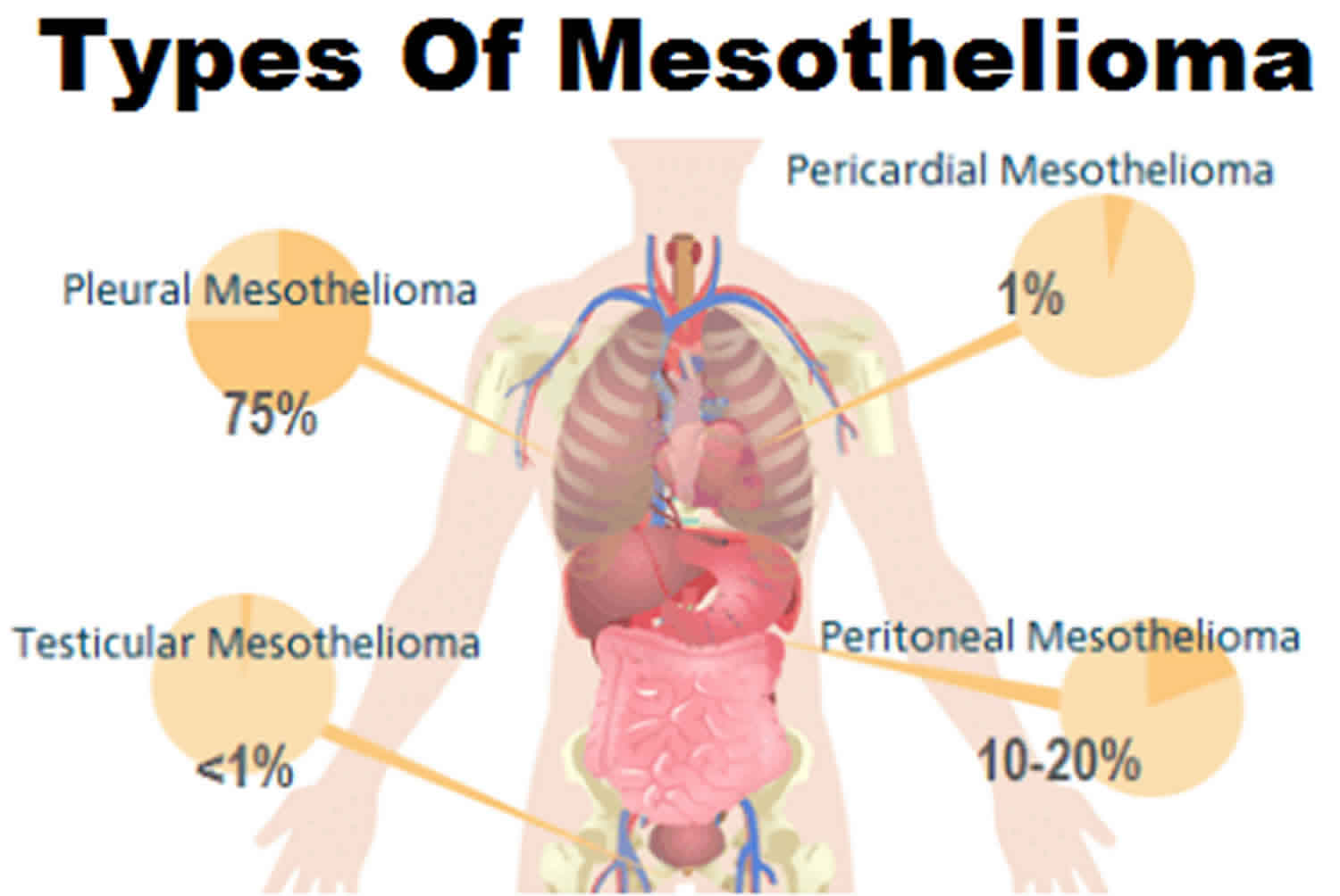 Mesothelioma Cancer Causes Symptoms Diagnosis Prognosis Treatment