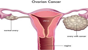 ovarian cancer