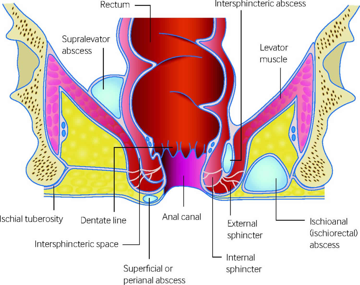 perianal abscess