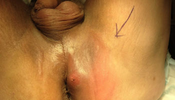perianal_abscess
