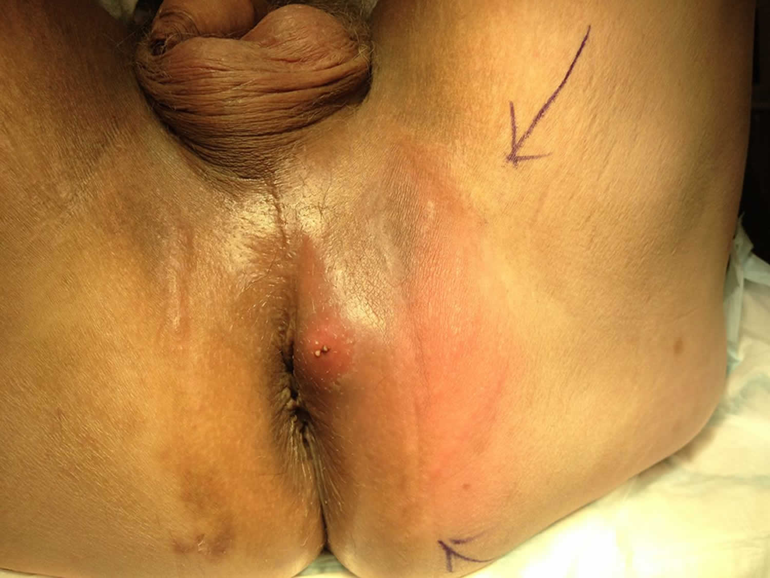 Perianal abscess