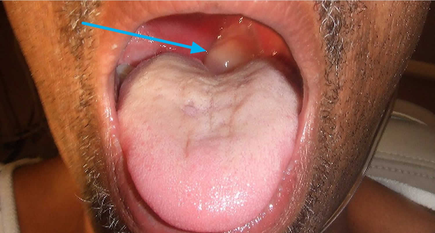 Peritonsillar Abscess Causes Signs Symptoms Diagnosis And Treatment