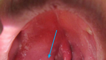 peritonsillar abscess