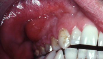 signs of abscess tooth