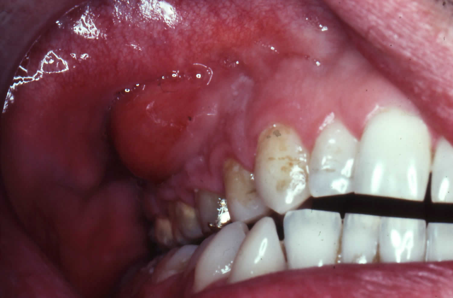 Abscess tooth, dental abscess causes, signs, symptoms ...