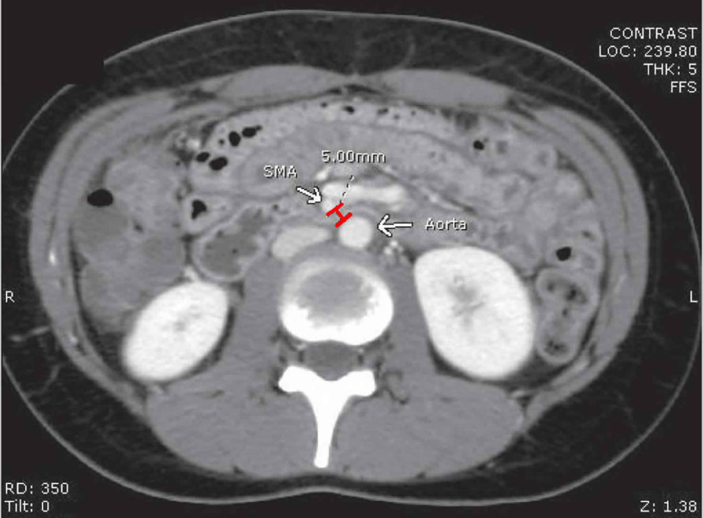 mesenteric-artery-anatomy-function-branches-mesenteric-artery-ischemia