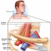 thoracic outlet syndrome