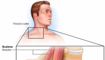 thoracic outlet syndrome